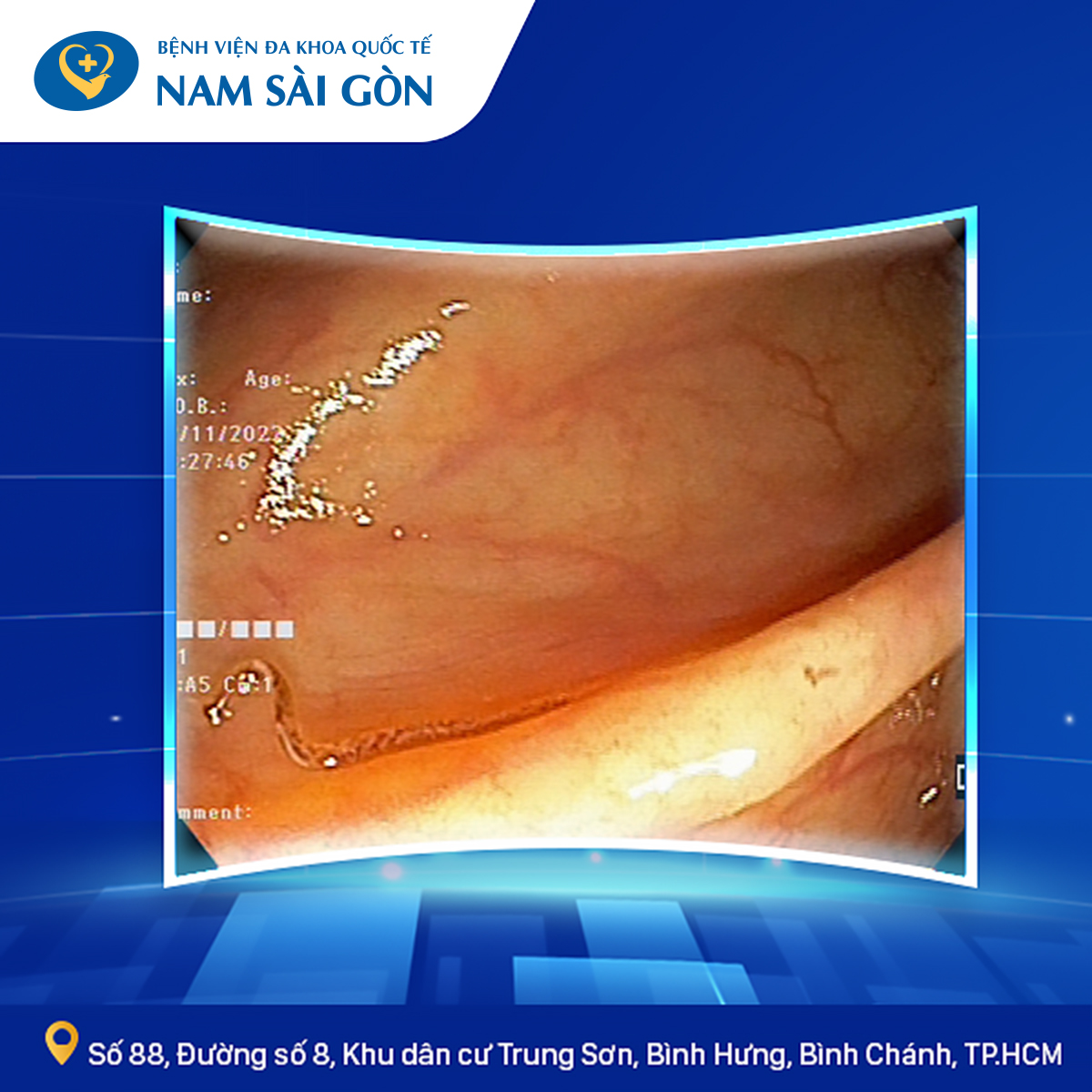 PHÁT HIỆN Ổ GIUN MÓC QUA NỘI SOI ĐẠI TRỰC TRÀNG