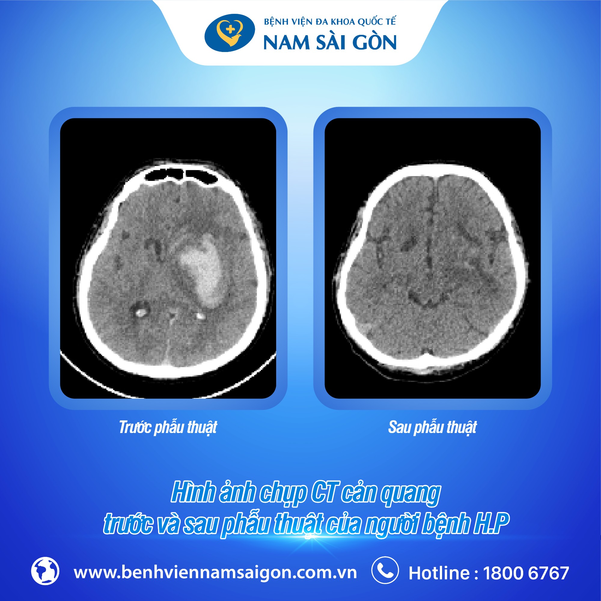 Hình Ảnh Chụp CT Cản Quang Trước Và Sau Phẫu Thuật Của Người Bệnh