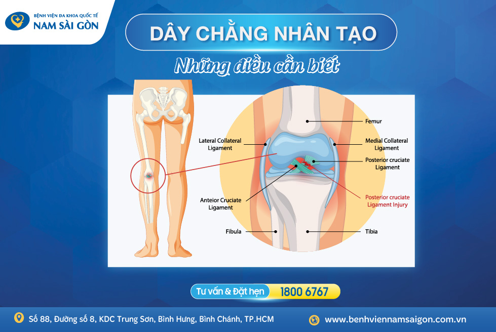 Dây chằng nhân tạo - Những thông tin cần biết