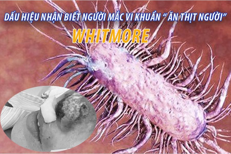 Dấu hiệu nhận biết người mắc vi khuẩn “ ăn thịt người” whitmore – có thể tử vong sau 48h.