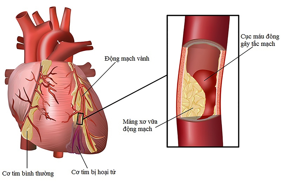 Phòng ngừa bệnh viêm cơ tim bằng cách nào?